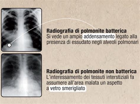 differenza tra polmonite batterica e virale